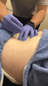 A man in a blue shirt is getting a tummy tuck with dry needling.