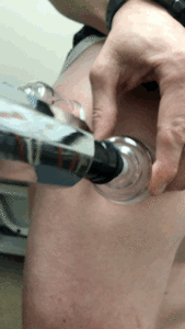 A person is cupping a device on a person's thigh.