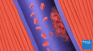 An image of a vein with thrombosis.