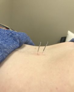 Dry needling needles on a person's stomach.