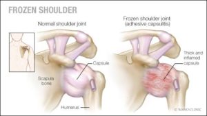 An illustration of a shoulder that is frozen.