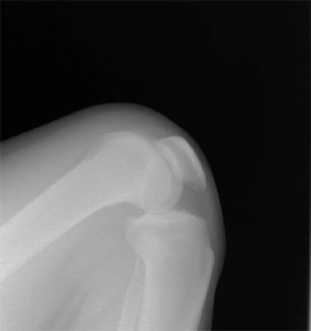 A knee x-ray moving picture.