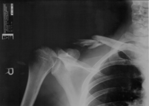 An x-ray of a clavicle in a skeleton.