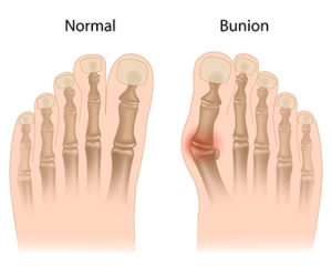 The difference between bunions and normal bunions.