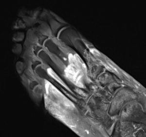 A tearful black and white image of a foot.