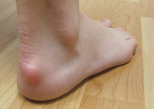 A person's foot on a wooden floor with Haglund's on the heel.