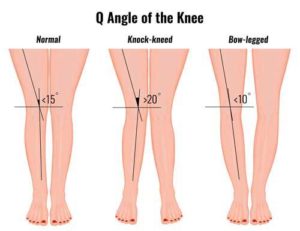 Q angle measurement of the knee.