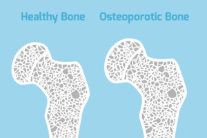 Osteoporosis and bone health.