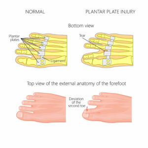 Plantar plate tear injury of the foot.