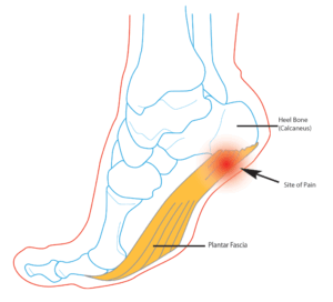 A Diagram of a Foot Pain With Labeling