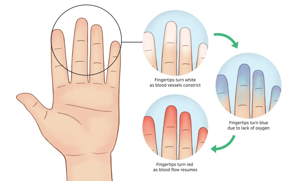 Raynaud's Disease - Farnsworth Orthopedic Physical Therapy