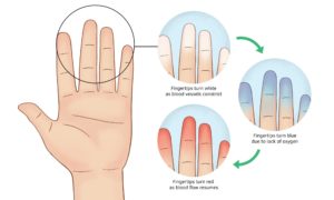 A diagram illustrating the stages of Raynaud's phenomenon affecting a person's hand.