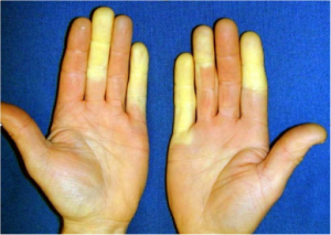 A person's hands with yellow fingernails showing signs of Raynaud.