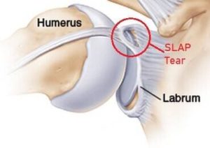 Diagram showing the location of a labrum tear.